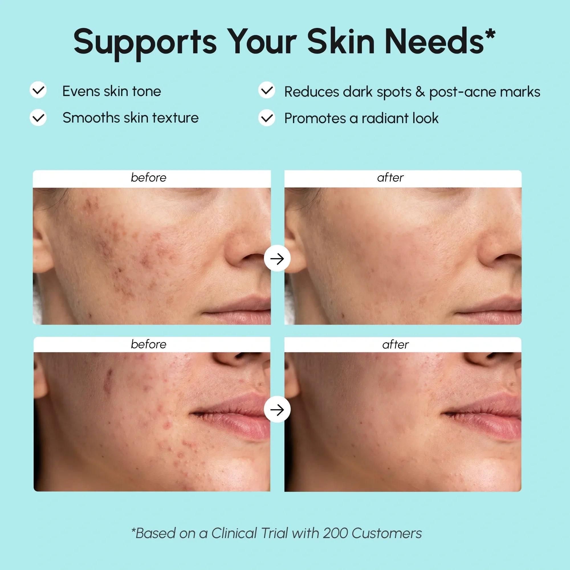 Azelaic Acid Cream